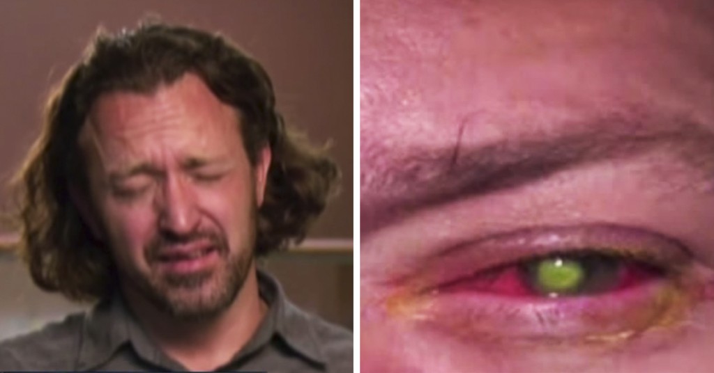 Sover du med kontaktlinsene dine? Det kan bli skummelt