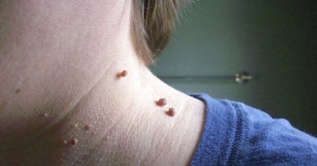 Slik fjerner du hudfliker med eplecidereddik