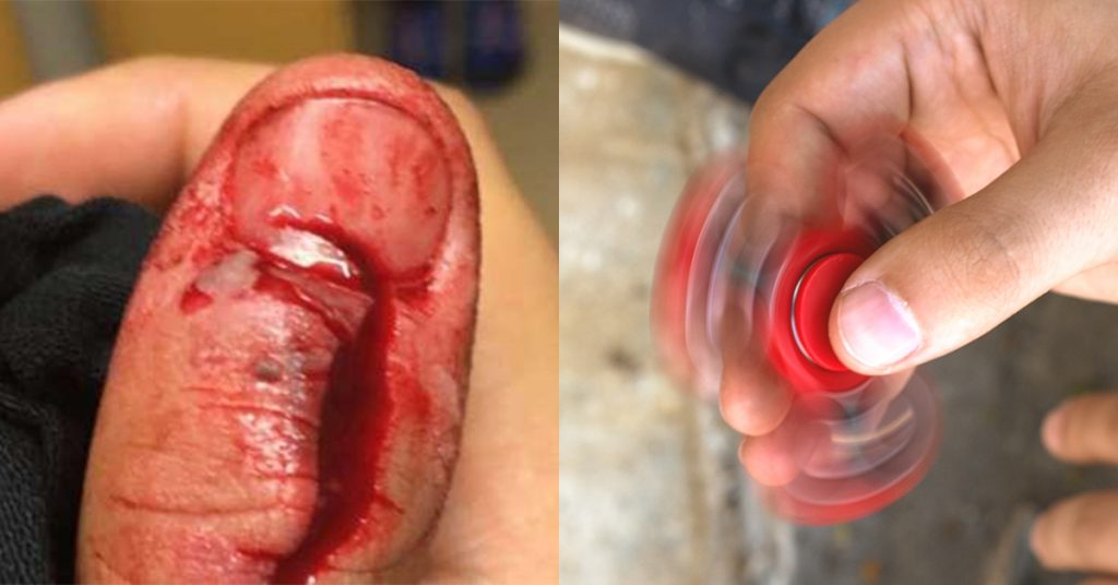 Fidget-spinneren eksploderte i hånden til Alexander