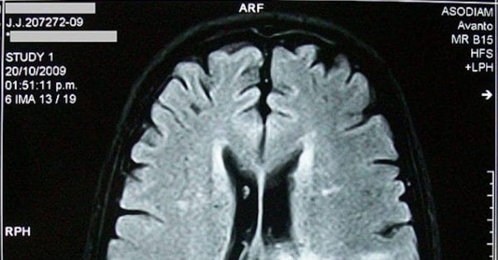 Ny forskning: Er du glemsk? Studie viser at du da kan være uvanlig intelligent